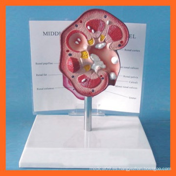 Medical Kidney Model Modelo Anatómico de Piedras Renales